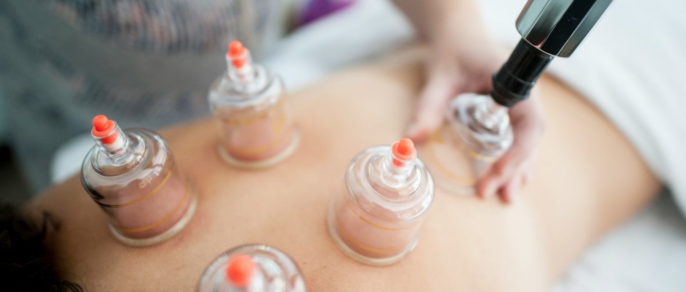 la technique de ventouses chinoises